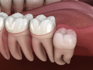 broken wisdom tooth extraction cost