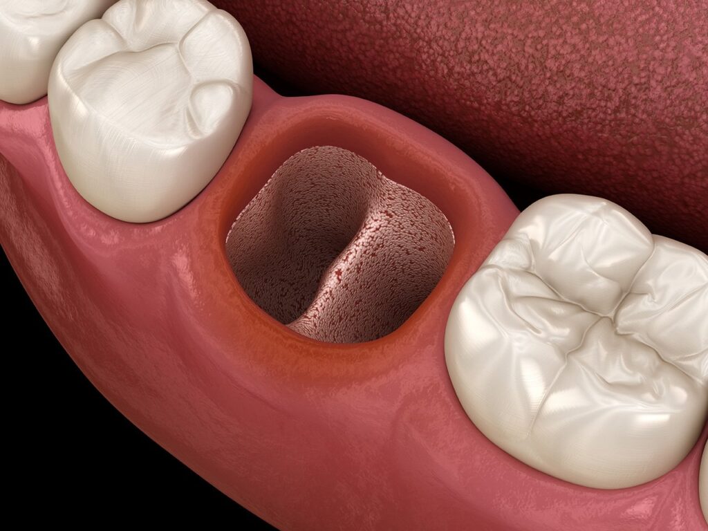 dry socket vs blood clot