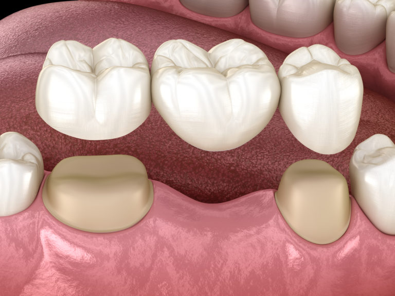 dental bridge procedure